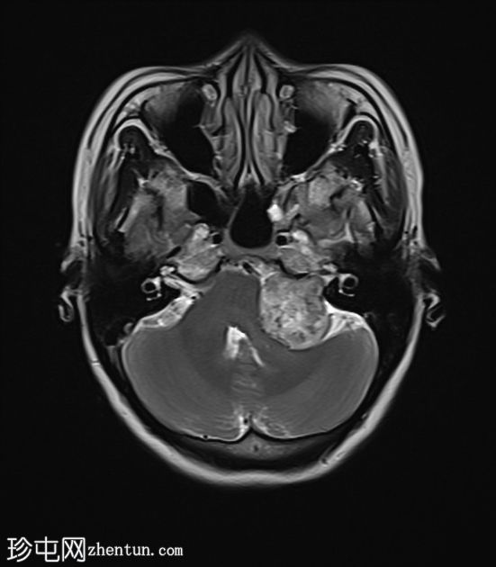 前庭神经鞘瘤