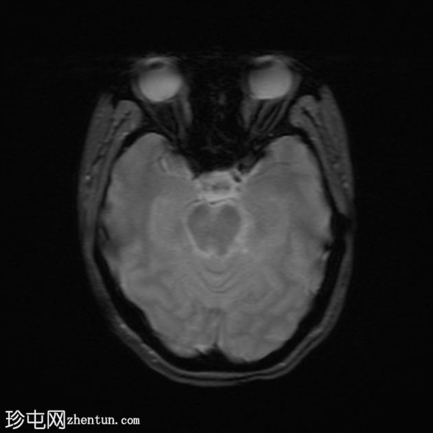 前庭神经鞘瘤