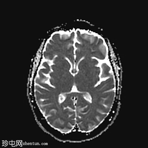 韦尼克脑病