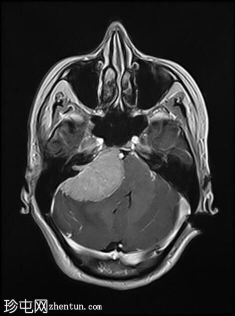 脑膜瘤 - 小脑桥脑角