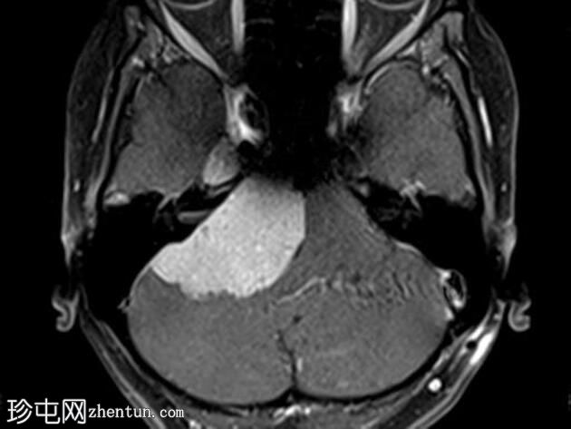脑膜瘤 - 小脑桥脑角