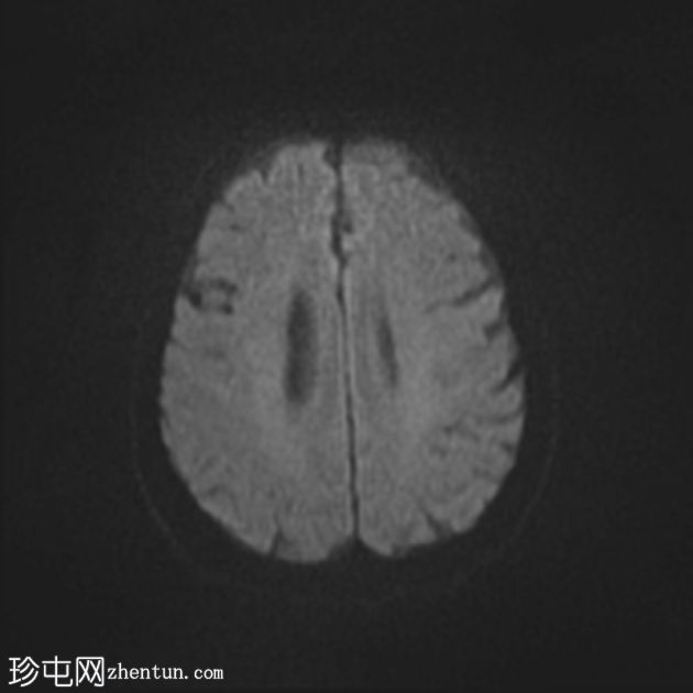 巨大颈内动脉瘤