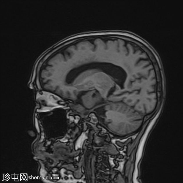 巨大颈内动脉瘤