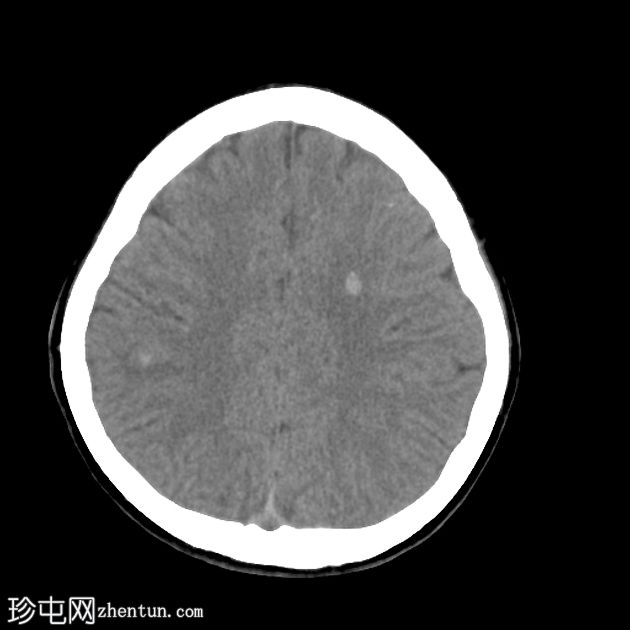 多发性脑海绵状畸形