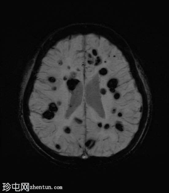 多发性脑海绵状畸形