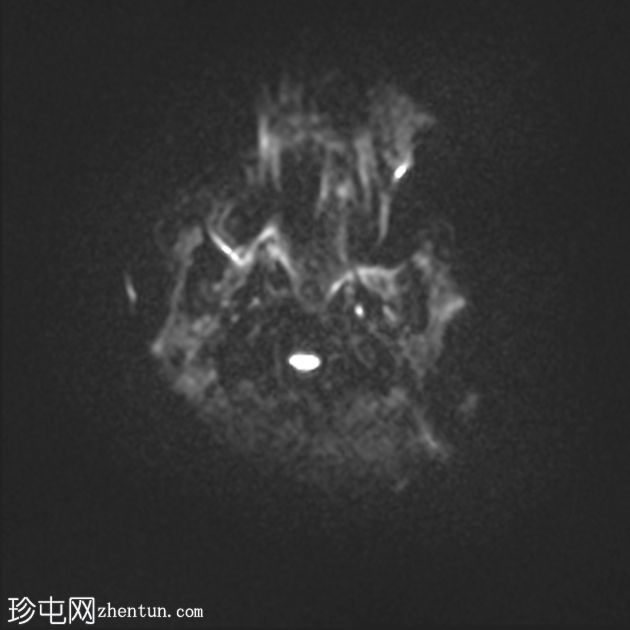 促纤维增生性婴儿神经节胶质瘤/星形细胞瘤