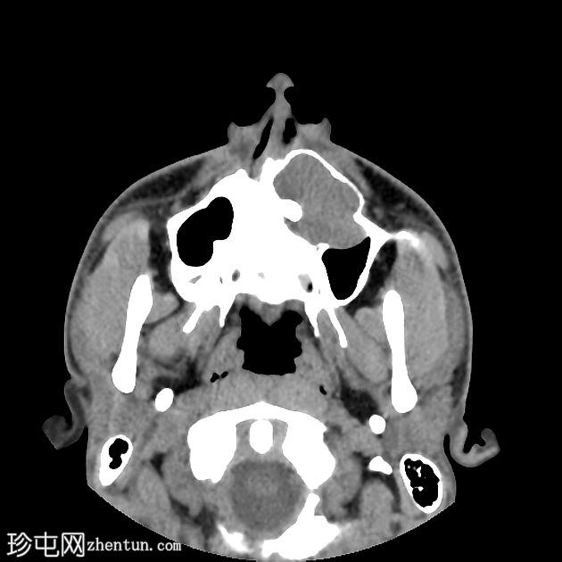 含牙囊肿