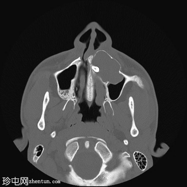 含牙囊肿