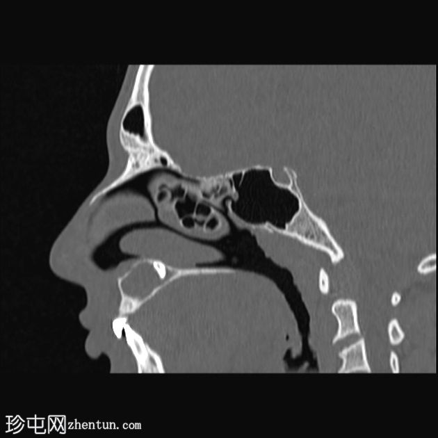 含牙囊肿