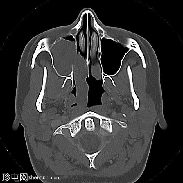 上颌窦后鼻孔息肉