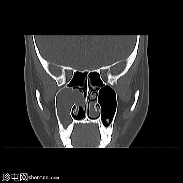 上颌窦后鼻孔息肉