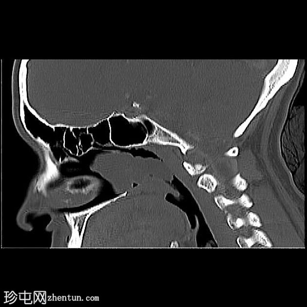 上颌窦后鼻孔息肉