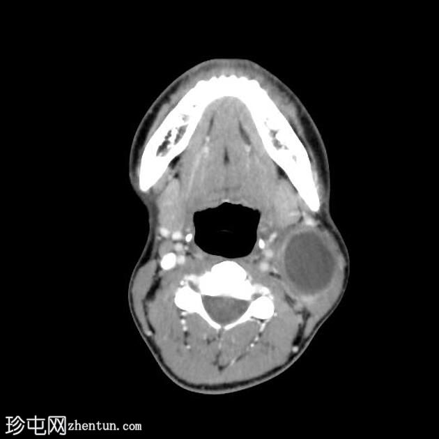 感染性第二鳃裂囊肿