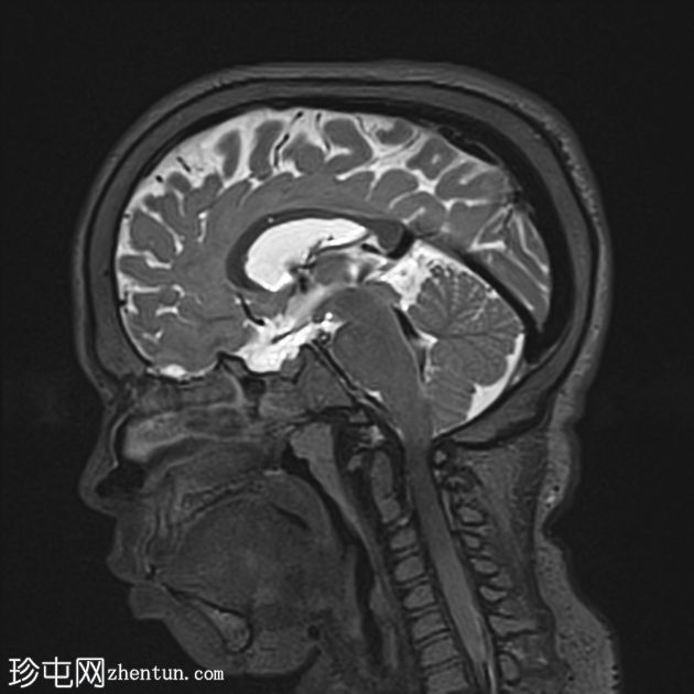 Hurler-Scheie 综合征