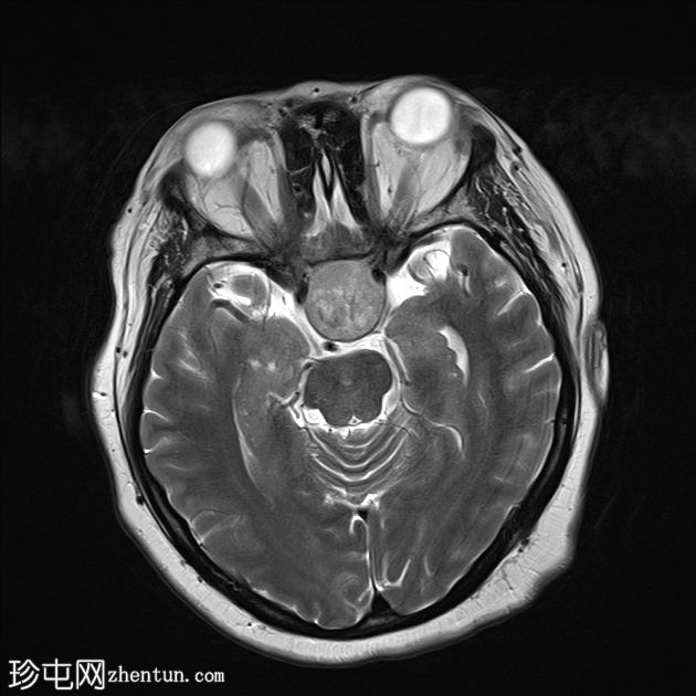 垂体大腺瘤