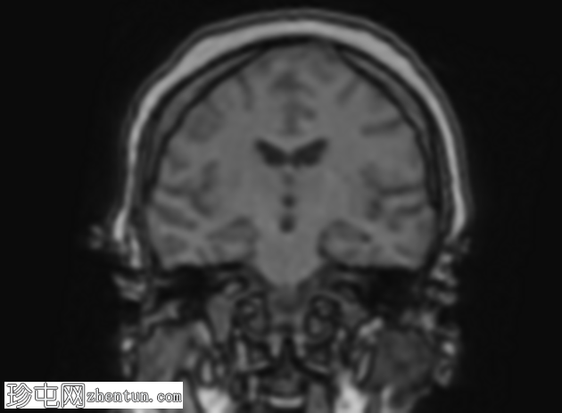 垂体大腺瘤