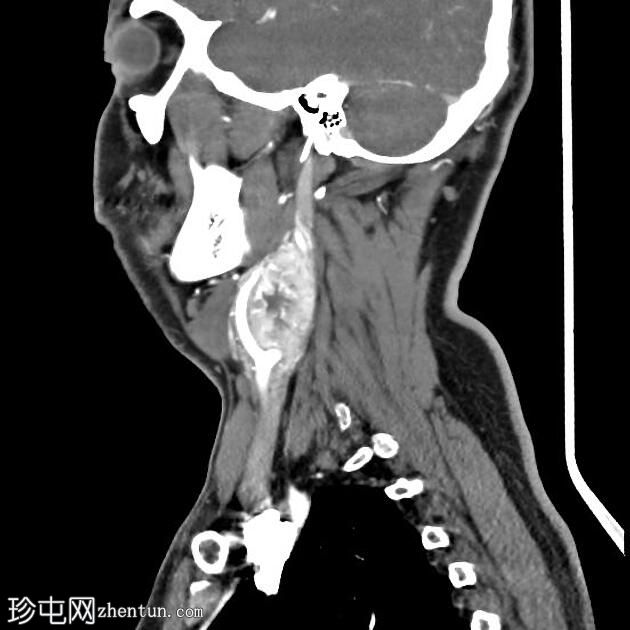 颈动脉体肿瘤