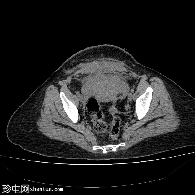 剖腹产伤口感染并形成脓肿