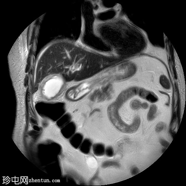 急性结石性胆囊炎