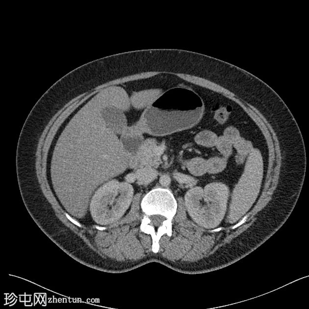 部分背侧胰腺发育不全