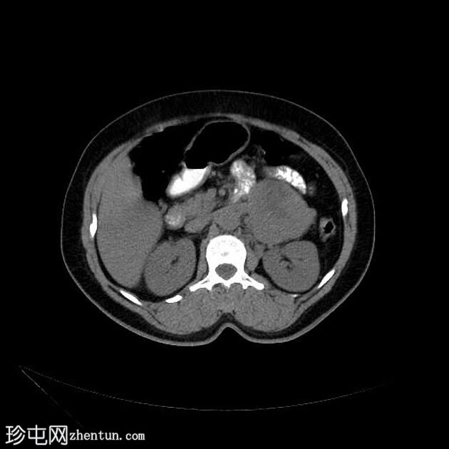 胰腺神经内分泌肿瘤