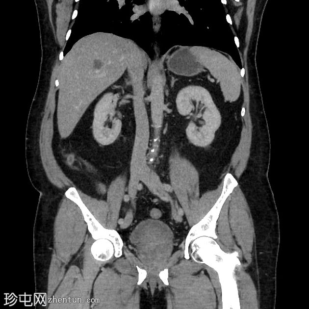 急性阑尾炎 - 无并发症的盲肠后