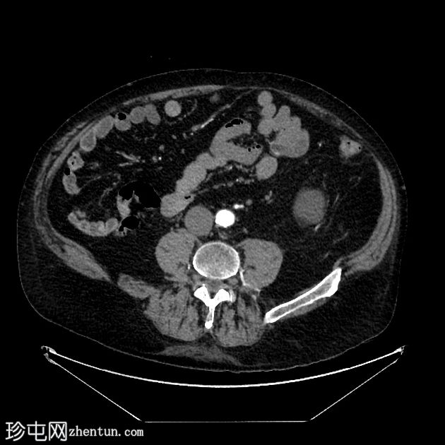 乳糜尿和肾细胞癌转移至胰腺