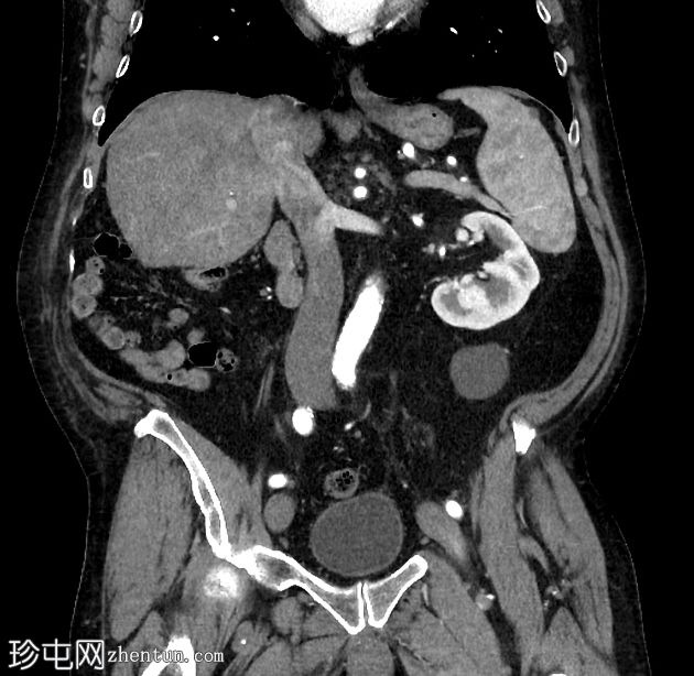 乳糜尿和肾细胞癌转移至胰腺