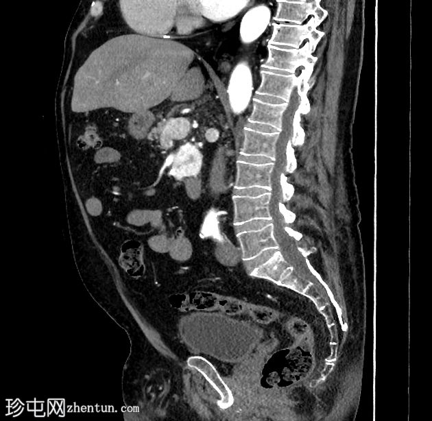 乳糜尿和肾细胞癌转移至胰腺