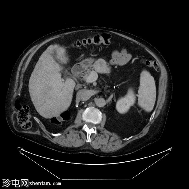 乳糜尿和肾细胞癌转移至胰腺