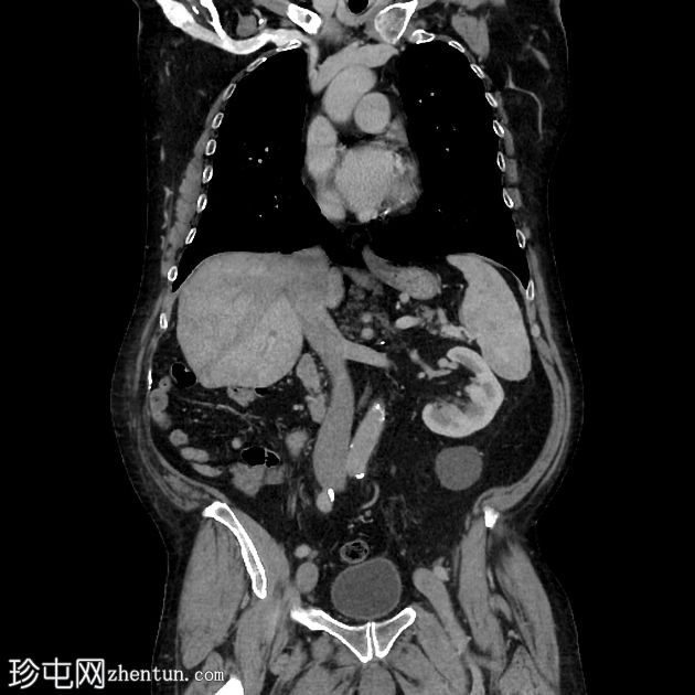 乳糜尿和肾细胞癌转移至胰腺