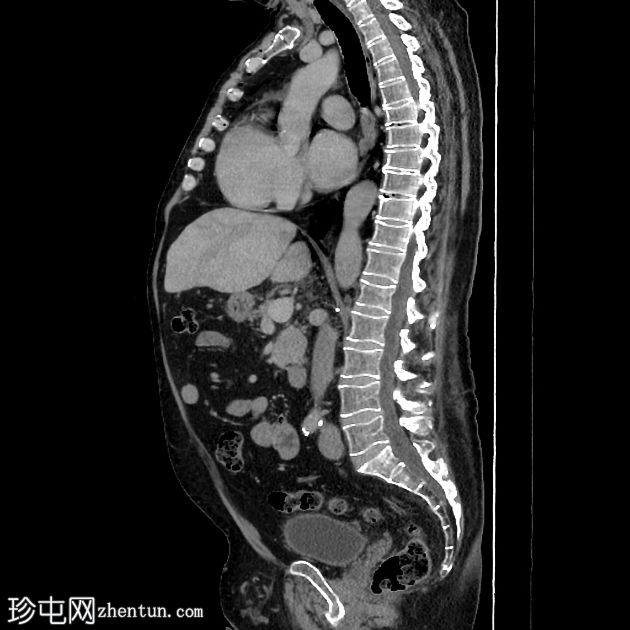 乳糜尿和肾细胞癌转移至胰腺