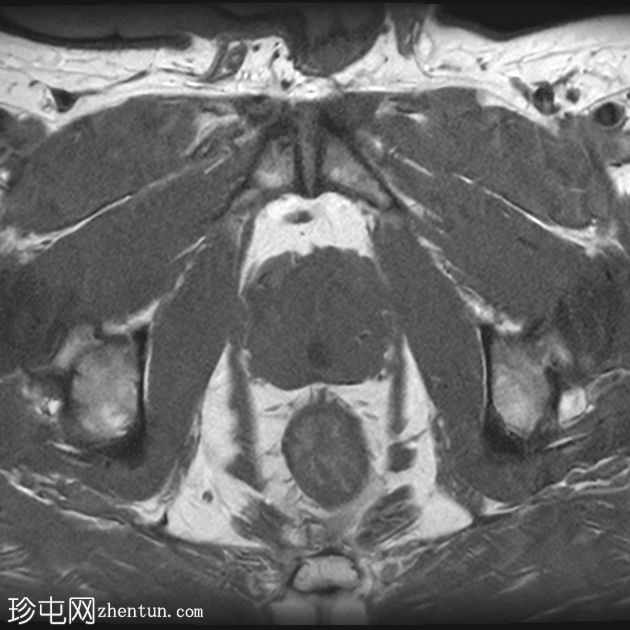 前列腺囊肿