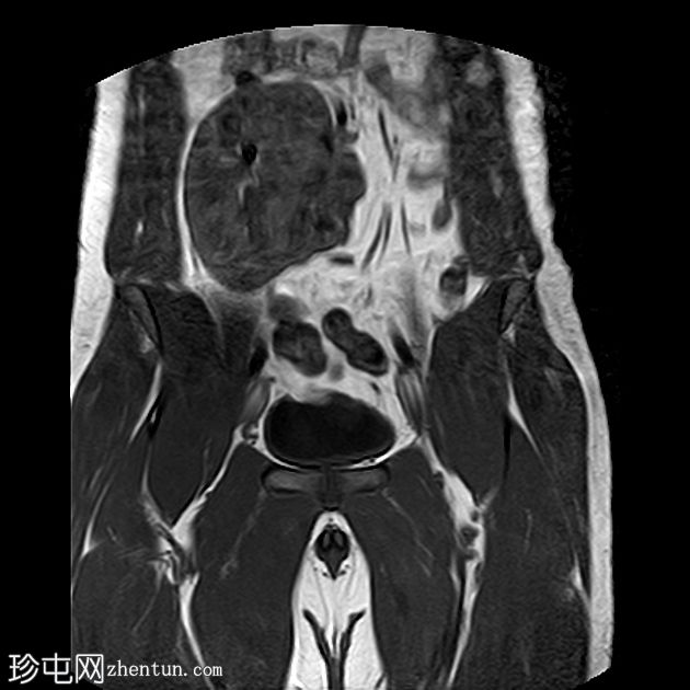 饼肾和隐睾