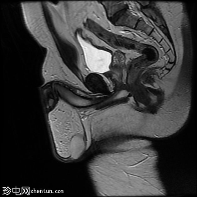 含脂肪的腹股沟阴囊疝