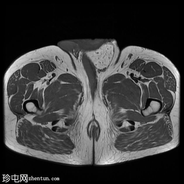 含脂肪的腹股沟阴囊疝