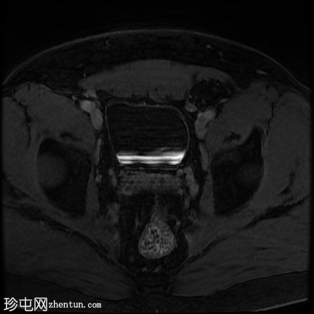 含脂肪的腹股沟阴囊疝