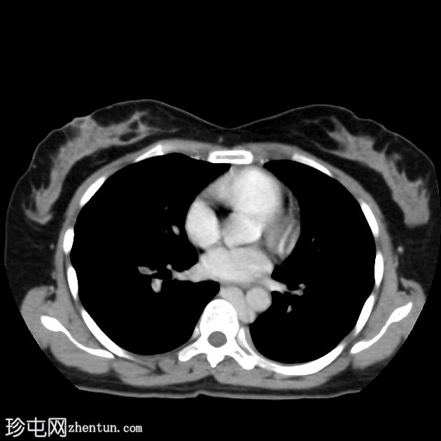 肺栓塞和下腔静脉奇静脉延续