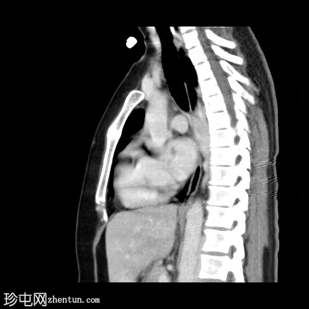 肺栓塞和下腔静脉奇静脉延续