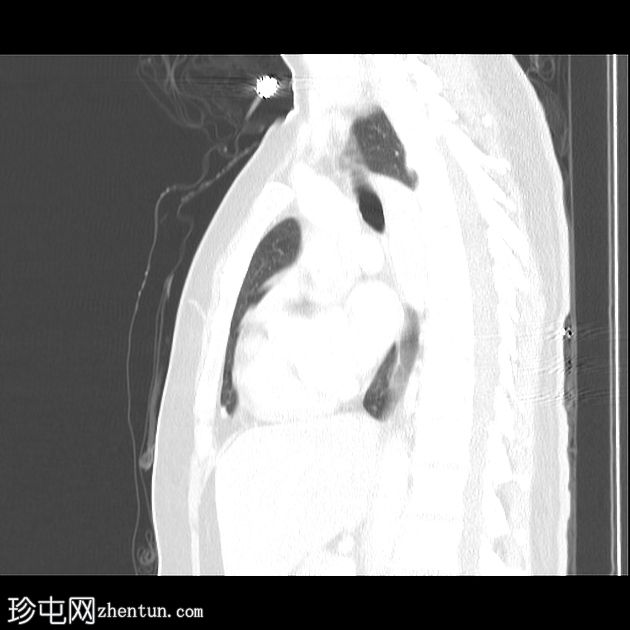 肺栓塞和下腔静脉奇静脉延续