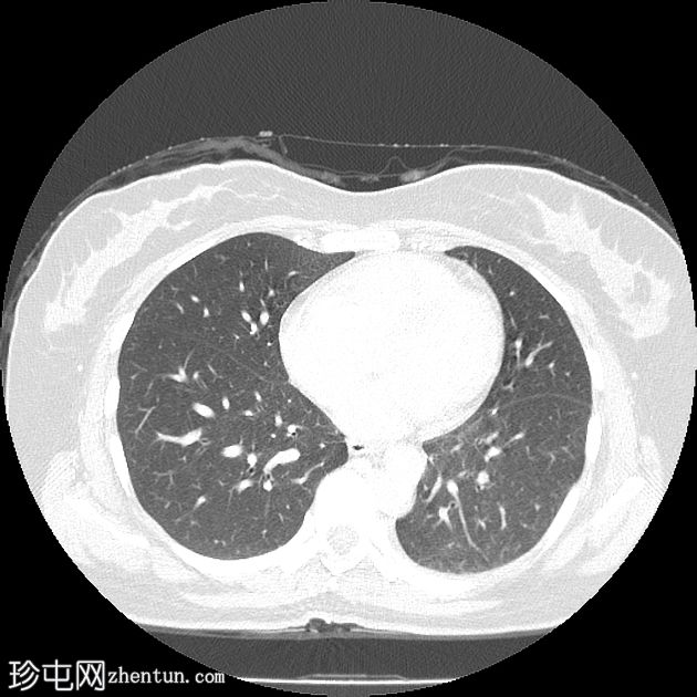 肺栓塞和下腔静脉奇静脉延续