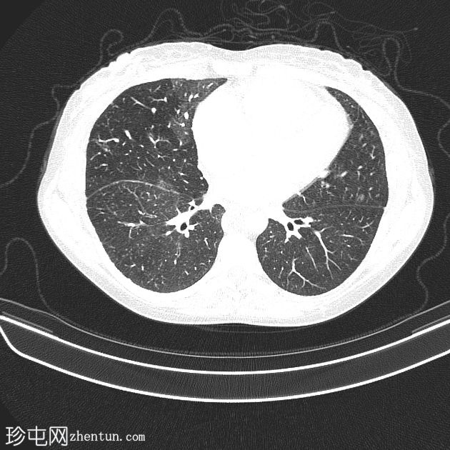 慢性肺栓塞