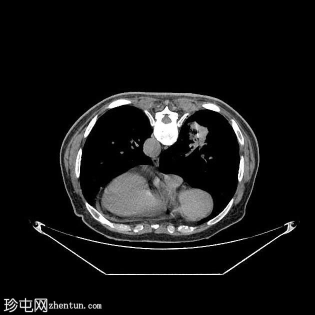 CT 引导下胸部活检-右肺肿块