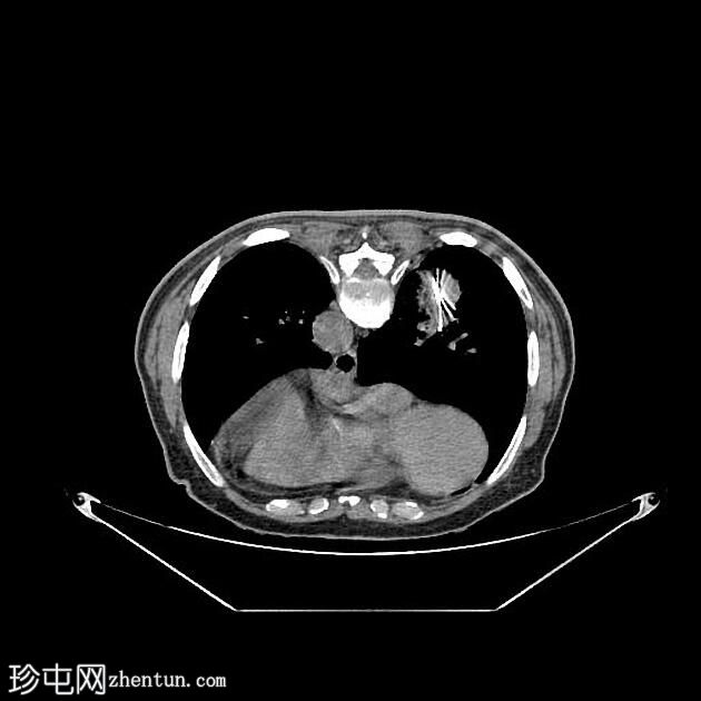 CT 引导下胸部活检-右肺肿块