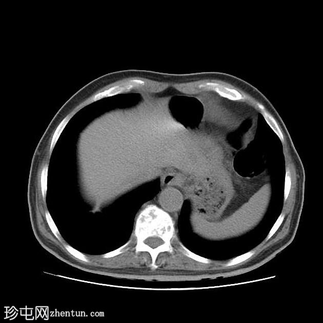 CT 引导下胸部活检-右肺肿块