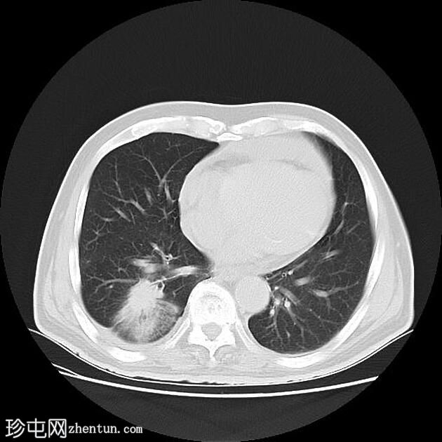 CT 引导下胸部活检-右肺肿块