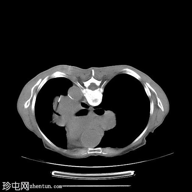 CT 引导下肺活检：肺门肿块