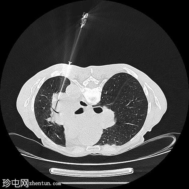 CT 引导下肺活检：肺门肿块