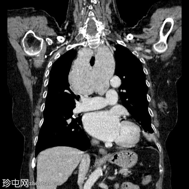 胸骨下甲状腺肿