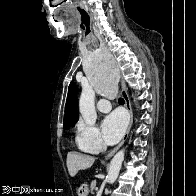 胸骨下甲状腺肿